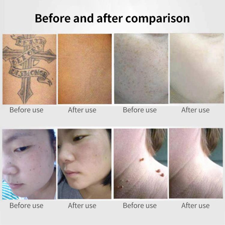 AA-A401 Portable Laser Beauty Instrument Mole Removal Freckle Removal Beauty Laser Pen, Specification:Red Light Plug-in - free shipping - PMC TechLife - Order now!