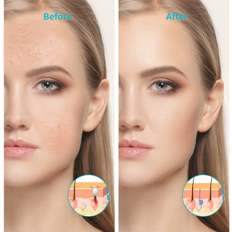 XPREEN XPRE052 Wireless Rechargeable Light Acne Treatment Device Home Acne Clearing Eraser with Blue Light and Red Light(White) - free shipping - PMC TechLife - Order now!