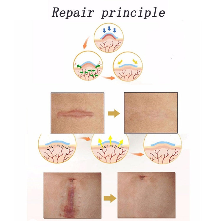 Organic silicone Gel Scar Therapy Patch  be Washed and Reused - free shipping - PMC TechLife - Order now!