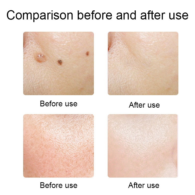 FY-106 Portable Mole and Freckle Removal Pen Household Laser Beauty Equipment(Green) - Clothing & Beauty by PMC TechLife | Online Shopping South Africa | PMC TechLife